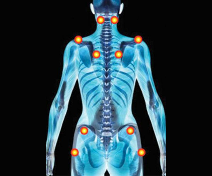 La fibromyalgie - infos