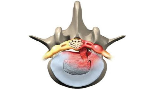 Hernie discale - Infos