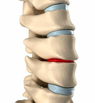 Discopathie dégénérative - Tout savoir