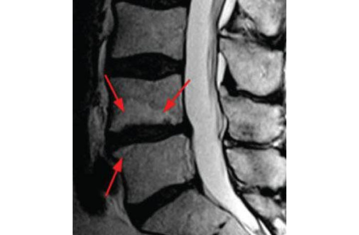 Le pincement discal - infos