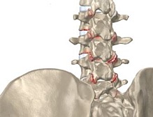 Arthrose et craquement des articulations : un lien ?