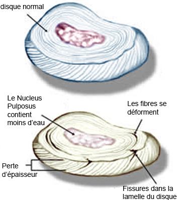 Réhydratation des disques